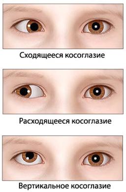 Косоокість у дорослих. Лікування приховане, розходиться, операція, вправи, причини виникнення, як виправити